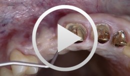 Implantation mit gleichzeitiger Augmentation