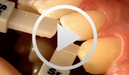 Composite Restoration in Anterior Teeth