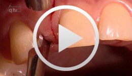 Single Tooth Replacementwith Implants in the Esthetic Region
