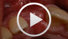 Implantatfreilegung mit Rolllappentechnik und Bindegewebetransplantation im Frontzahnbereich
