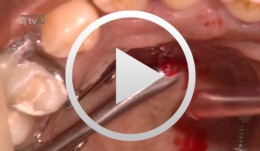 Gaumenimplantat und Kortikalisschrauben als KFO-Verankerungselement