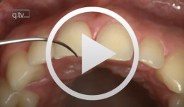 Gap Closure with a Minor Incisal Edge Restauration