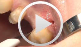 Internal Sinus Lift with the Lift Control System