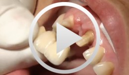 Implant-borne restorations (3rd edition)