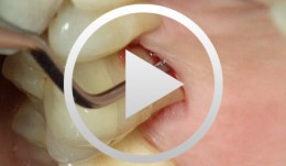 PSI - the Periodontal Screening Index