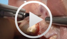Bone Transplantation with Systemized Armamentarium