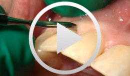 Implantatgetragener Zahnersatz (Ästhura Implants) und Kronen aus Zirkoniumdioxid
