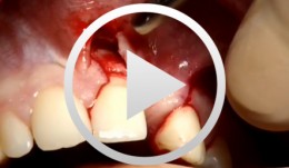 Knochenaugmentation mit autologem Knochen