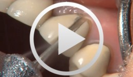 Preparation of Crowns and Bridges