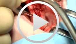 Crestale Knochenelevation, ein Patientenfall