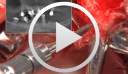 Bone Spreading, Bone Condensing (Interim Control System)