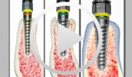 Split Control System, Spreading am Modell und am Patienten