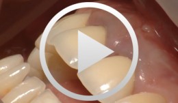 New extraction system for anteriors with subsequent immediate implantation