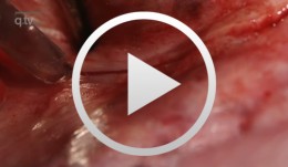 Distraktionsosteotomie Unterkiefer