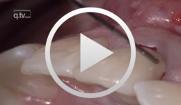 Soft Tissue Management in Immediate Implantation in Region 21