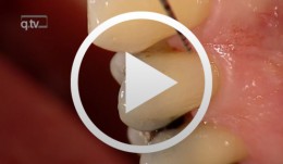 Regenerative Therapie an Zahn 14 und 24
