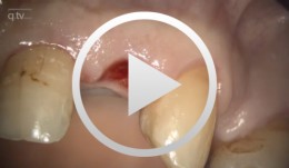 Immediate Implant Placement in the 12 and 22 Region