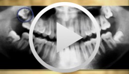 Operative Therapiekonzepte retinierter Oberkieferzähne