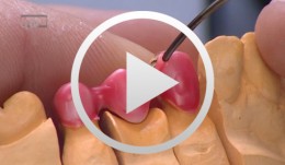 Zirconia Ceramic Restorations Vennered Using the Overpress Technique, part 2