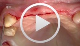 Preimplant Augmentation Procedures to Improve the Hard Tissue Situation in the Upper Anterior Region