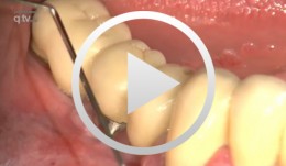 Implantatplastik und freies Bindegewebstransplantat Regio 45