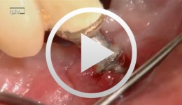 Implantatplastik und freies Schleimhauttransplantat Regio 42