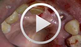 Ridge augmentation in the periodontally involved dentition