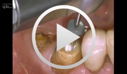 Core & Post System Post Cementation and Core Build Up