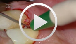 Parodontale Regeneration bei 21, 23 mit EMD und kortikalen Knochenchips
