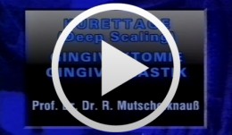 Kürrettage: Gingivektomie, Gingivoaplastik