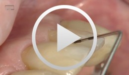 Passive-fit Brückenversorgung auf Implantaten in der Oberkieferseitenzahnregion