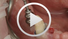 Clinical implant prosthodontics - step by step