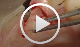 Immediate placement of a NobleActive implant in a patient with a pronounced hard-tissue and soft-tissue defect