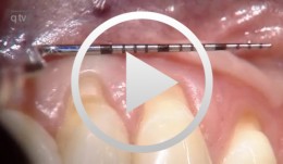 Recession coverage using human dermal tissue at site 22-26