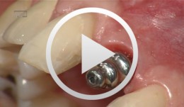 Implantatgetragene Krone regio 21