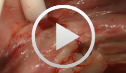 Implantation mit Facilitate 3D Planung, provisorischer Sofortversorgung und definitiver Versorgung mit Atlantis Abutments und Zirkonoxidbrücke