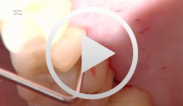 Treatment of a palatal class II furcation
