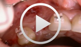 Navigated implantation and connective-tissue graft