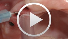 Clinical implant prothodontics - Part II