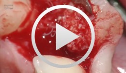 Anterior implant with concurrent bone augmentation (GBR)