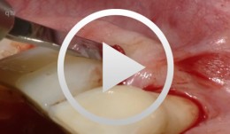 Flap surgery using a modified papilla preservation technique