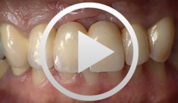 Implant Bone Dentures with Bone Augmentation and Soft Tissue Transplantation for Papillary Regeneration (Clinic and Laboratory)