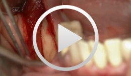Sandwich osteotomy in the posterior mandible