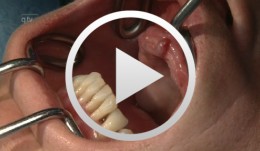 Maxillary coverdenture on 6 implants Stent-guided implant insertion (NobelGuide) and immediate loading