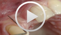 Cocoon-technique containment and contouring