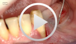 Insertion von drei Implantaten im Unterkiefer Seitenzahnbereich nach erfolgtem Knochenaufbau mit der Kompaktaplatten-Technik