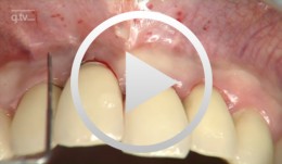 Soft-tissue management around maxillary anterior implants