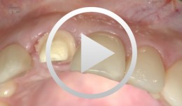 Immediate implant placement and restoration of tooth 21 with augmentation of the buccal wall with autologous bone