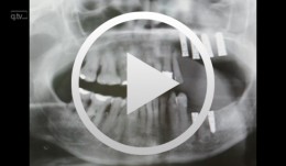 Vestibulumplastik mit Schleimhauttransplantat bei Implantatfreilegung nach Oberkieferrekonstruktion