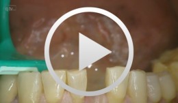 Implant placement in the anterior mandible with bone augmentation